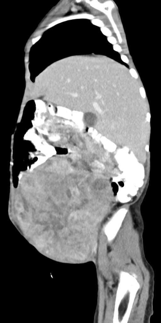 Abdominopelvic rhabdomyosarcoma (Radiopaedia 78356-90984 Sagittal C+ portal venous phase 76).jpg