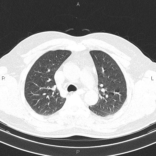 File:Aberrant right subclavian artery (Radiopaedia 87093-103354 Axial lung window 38).jpg