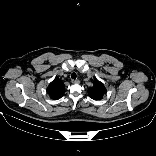 Aberrant right subclavian artery (Radiopaedia 87093-103354 Axial non-contrast 14).jpg