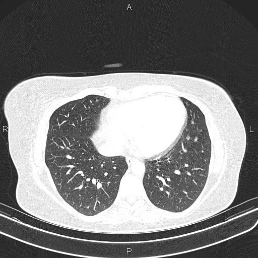 File:Aberrant right subclavian artery (Radiopaedia 87334-103629 Axial lung window 46).jpg