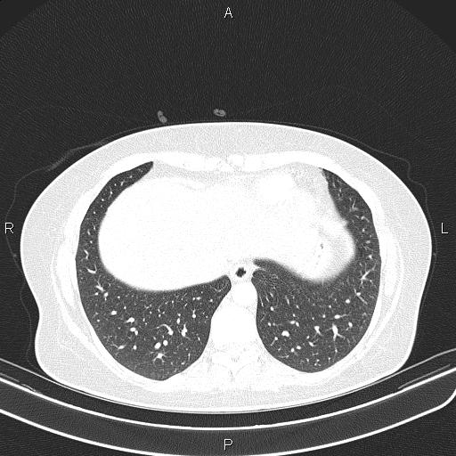 Aberrant right subclavian artery (Radiopaedia 87334-103629 Axial lung window 52).jpg