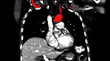 File:Aberrant right subclavian artery (Radiopaedia 9379-38993 Coronal 17).jpg