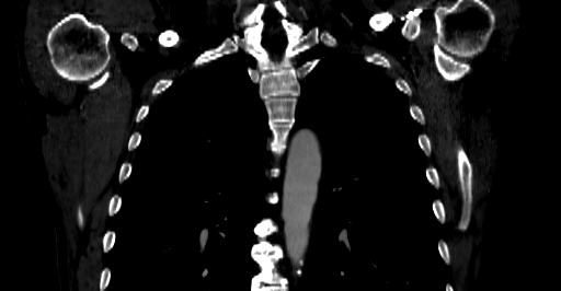 Accesory rib joint (Radiopaedia 71987-82452 Coronal bone window 20).jpg