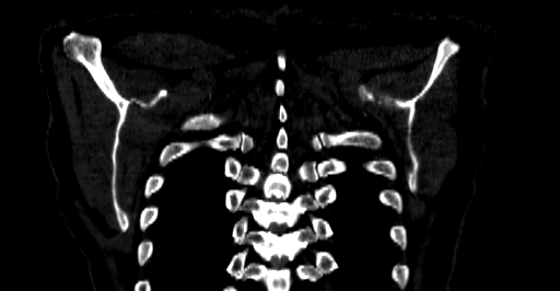 Accesory rib joint (Radiopaedia 71987-82452 Coronal bone window 75).jpg