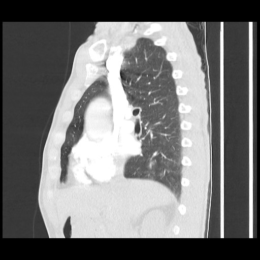 File:Accessory left horizontal fissure with lingular pneumonia (Radiopaedia 53763-59843 Sagittal lung window 29).jpg