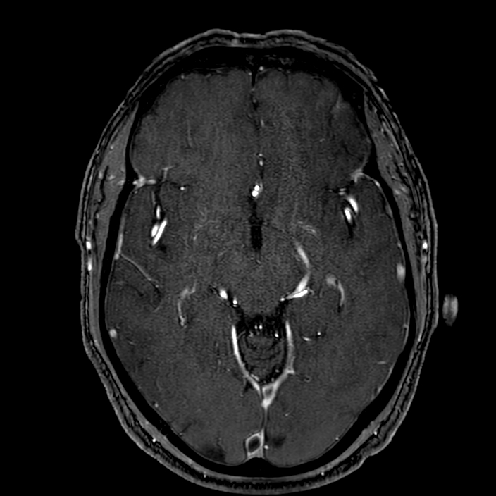Accessory middle cerebral artery (Radiopaedia 73114-83828 Axial MRA 85).jpg