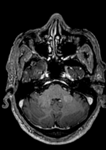 Accessory middle cerebral artery (Radiopaedia 73114-83828 Axial T1 C+ 128).jpg