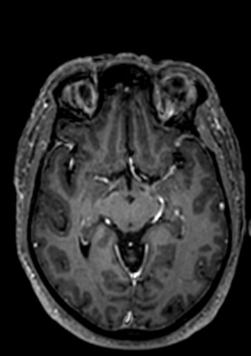 Accessory middle cerebral artery (Radiopaedia 73114-83828 Axial T1 C+ 60).jpg