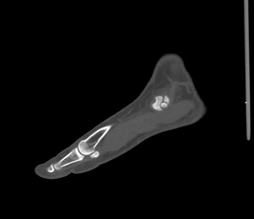 File:Accessory navicular bone (Radiopaedia 54999-61314 Sagittal non-contrast 20).jpg