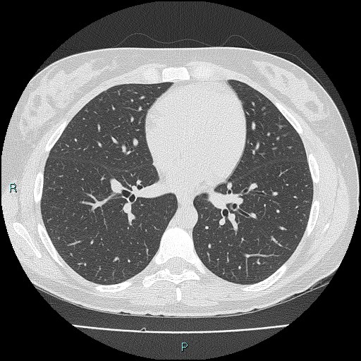 Accidental foreign body aspiration (seamstress needle) (Radiopaedia 77740-89983 Axial lung window 39).jpg