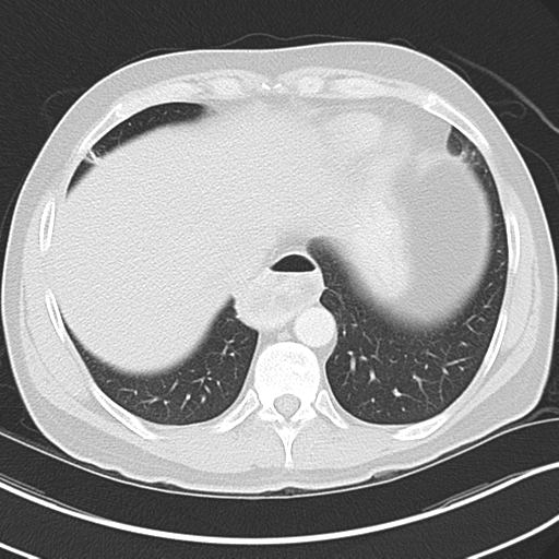 File:Achalasia of the cardia (Radiopaedia 38497-40595 Axial lung window 42).png