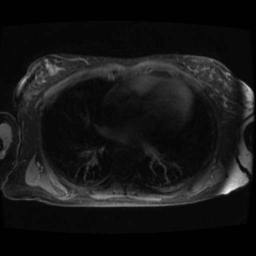 Acinar cell carcinoma of the pancreas (Radiopaedia 75442-86668 Axial late phase (~30 mins) 150).jpg