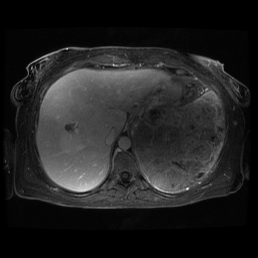 Acinar cell carcinoma of the pancreas (Radiopaedia 75442-86668 D 110).jpg