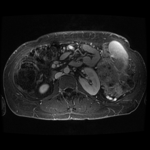 Acinar cell carcinoma of the pancreas (Radiopaedia 75442-86668 D 22).jpg