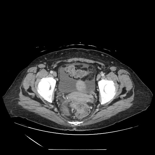 File:Acinar cell carcinoma of the pancreas (Radiopaedia 75442-86669 Axial C+ portal venous phase 134).jpg
