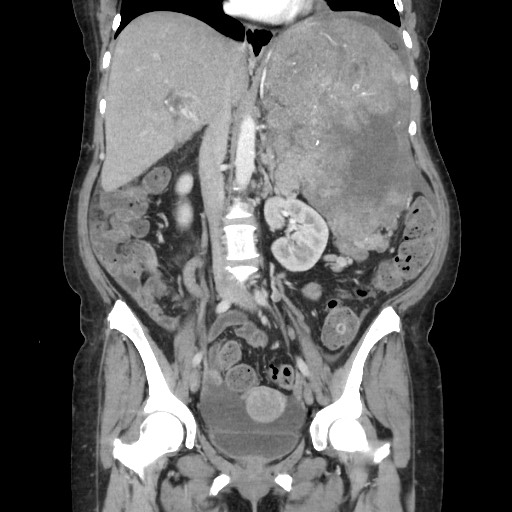 Acinar cell carcinoma of the pancreas (Radiopaedia 75442-86669 Coronal C+ portal venous phase 67).jpg