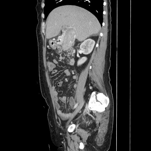 Acinar cell carcinoma of the pancreas (Radiopaedia 75442-86669 Sagittal C+ portal venous phase 74).jpg
