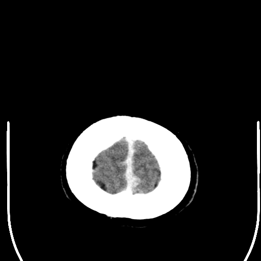 File:Acoustic schwannoma (Radiopaedia 39170-41389 Axial C+ 28).png
