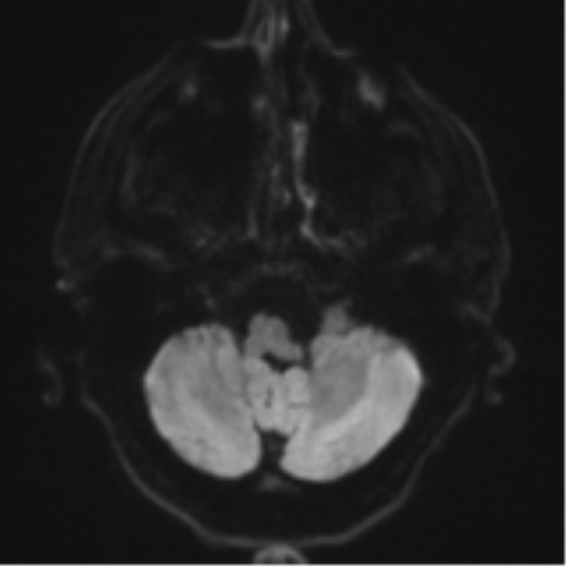 Acoustic schwannoma (Radiopaedia 55729-62281 E 30).png