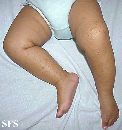 File:Acrodermatitis Infantile Papular (Dermatology Atlas 10).jpg