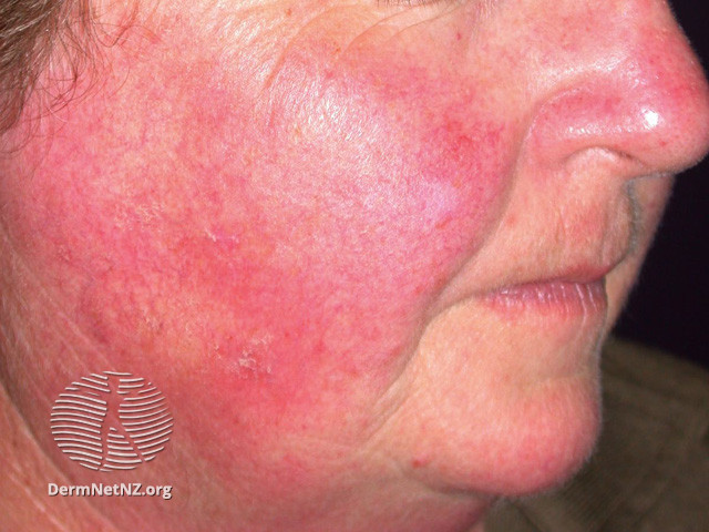 Actinic Keratoses treated with imiquimod (DermNet NZ lesions-ak-imiquimod-3738).jpg