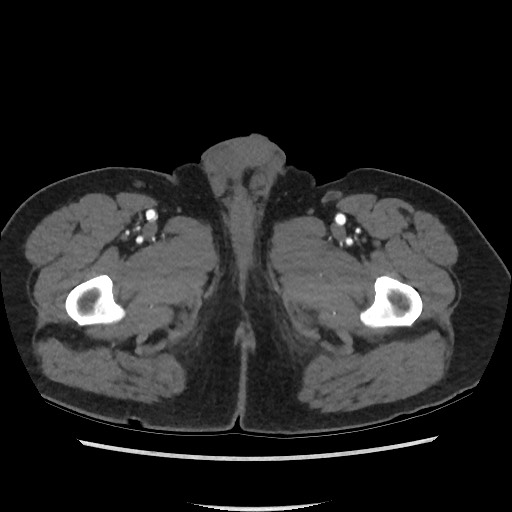 Active colonic bleed on CT (Radiopaedia 49765-55025 Axial C+ arterial phase 93).jpg