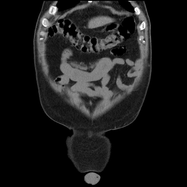 Active colonic bleed on CT (Radiopaedia 49765-55025 Coronal non-contrast 11).jpg