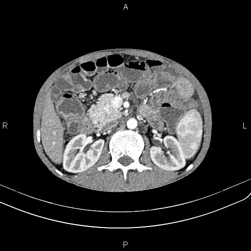 File:Active crohn disease (Radiopaedia 87133-103397 Axial C+ arterial phase 42).jpg
