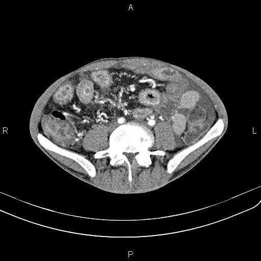 Active crohn disease (Radiopaedia 87133-103397 Axial C+ arterial phase 66).jpg