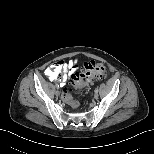 File:Active lower gastrointestinal bleeding - diverticular (Radiopaedia 61203-69106 Axial C+ portal venous phase 101).jpg