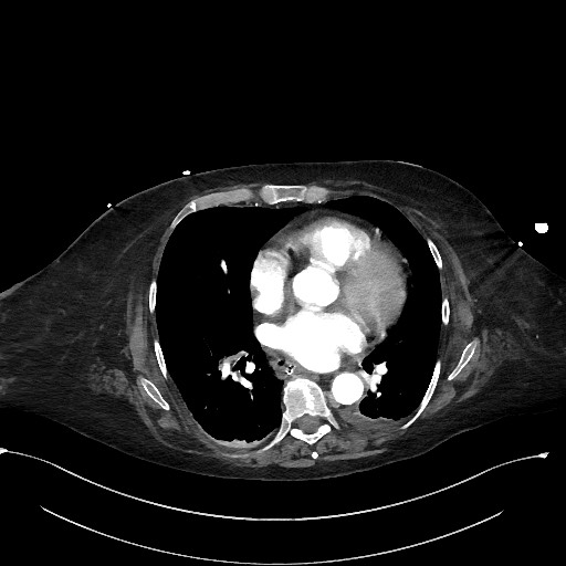 File:Active renal extravasation with large subcapsular and retroperitoneal hemorrhage (Radiopaedia 60975-68796 Axial C+ arterial phase 1).jpg
