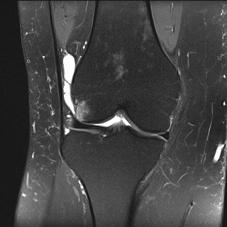 File:Acute-on-chronic transient lateral patellar dislocation with trochlear dysplasia (Radiopaedia 84099-99349 Coronal PD fat sat 22).jpg