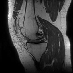 Acute-on-chronic transient lateral patellar dislocation with trochlear dysplasia (Radiopaedia 84099-99349 Sagittal PD 65).jpg