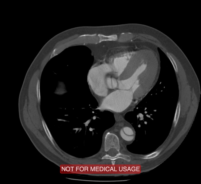 Acute aortic dissection - Stanford type A (Radiopaedia 40661-43285 Axial C+ arterial phase 45).jpg