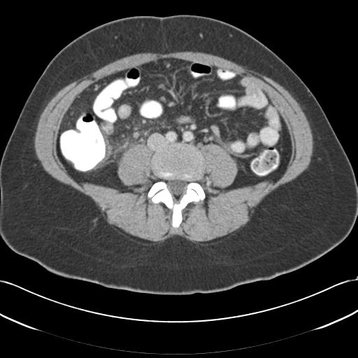 Acute appendicitis (Radiopaedia 30297-30934 Axial C+ portal venous phase 49).jpg