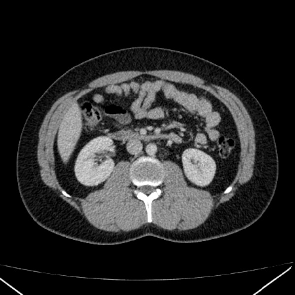 Acute appendicitis (Radiopaedia 38255-40270 Axial C+ portal venous phase 46).jpg