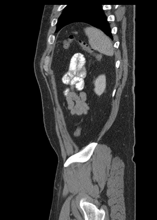 Acute appendicitis (Radiopaedia 48511-53463 Sagittal C+ portal venous phase 110).jpg