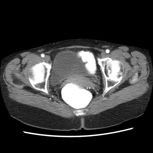 File:Acute appendicitis (Radiopaedia 52672-58589 Axial C+ arterial phase 32).jpg