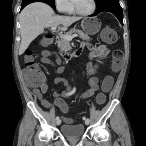 Acute appendicitis (Radiopaedia 66513-75790 Coronal C+ portal venous phase 31).jpg