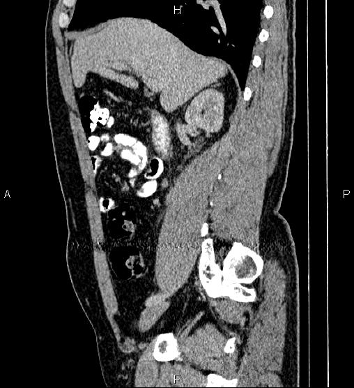 Acute appendicitis (Radiopaedia 84780-100240 Sagittal C+ portal venous phase 36).jpg