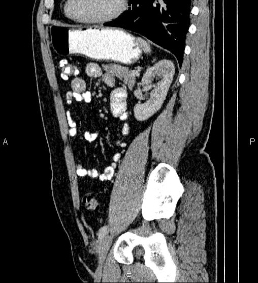 Acute appendicitis (Radiopaedia 84780-100240 Sagittal C+ portal venous phase 73).jpg