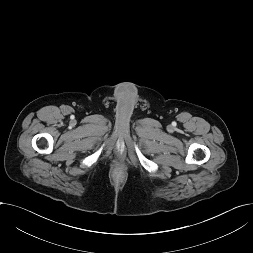 File:Acute appendicitis - large appendicoliths (Radiopaedia 61805-69820 Axial C+ portal venous phase 148).jpg