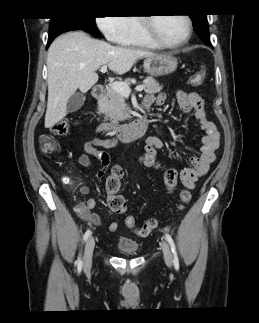 Acute appendicitis - large appendicoliths (Radiopaedia 61805-69820 Coronal C+ portal venous phase 54).jpg