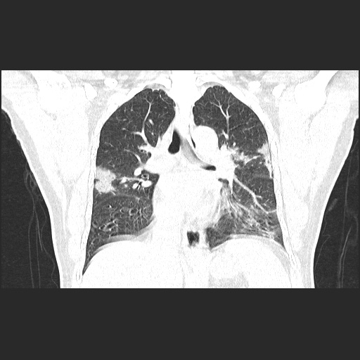 Acute appendicitis and COVID 19 pneumonia (Radiopaedia 76604-88380 G 36).jpg