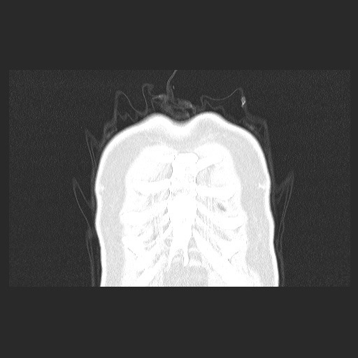 File:Acute appendicitis and COVID 19 pneumonia (Radiopaedia 76604-88380 G 7).jpg