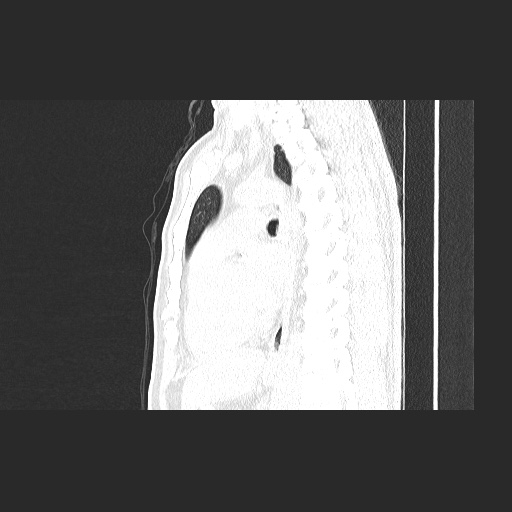 File:Acute appendicitis and COVID 19 pneumonia (Radiopaedia 76604-88380 Sagittal lung window 54).jpg