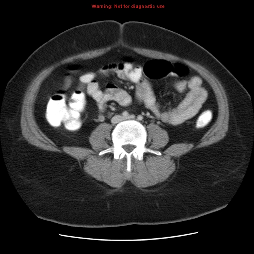 File:Acute appendicitis complicated by ovarian vein thrombophlebitis (Radiopaedia 16172-15851 Axial C+ portal venous phase 56).jpg