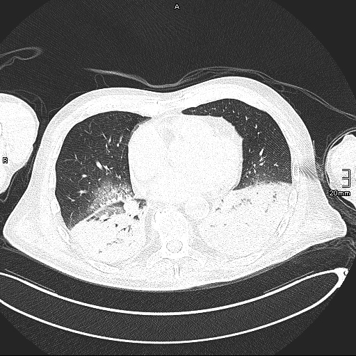 Acute aspiration pneumonitis (Radiopaedia 55642-62166 Axial lung window 101).jpg