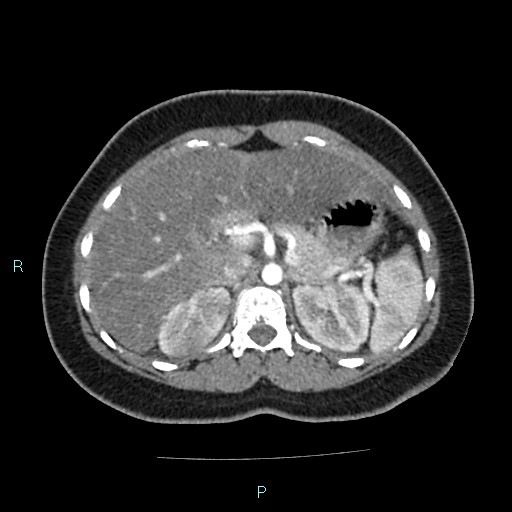 Acute bilateral pyelonephritis (Radiopaedia 37146-38881 Axial C+ arterial phase 53).jpg