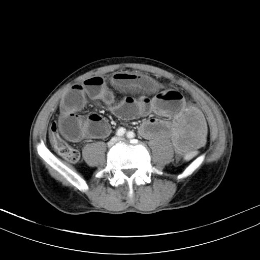 Acute bowel ischemia (Radiopaedia 87695-104114 Axial C+ portal venous phase 55).jpg
